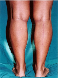 Implant gambe - Caz 1 - implant gambe