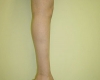 Implant gambe - Caz 2 - implant gambe
