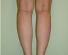 Implant gambe - Caz 5