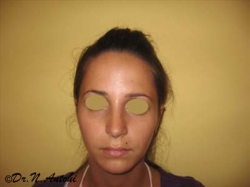 Rinoplastie primara - Caz 2
