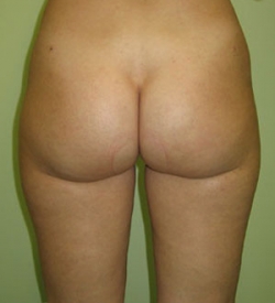 Lipoaspiratie - Caz 4