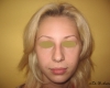 Rinoplastie primara - Caz 1