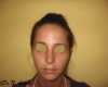 Rinoplastie primara - Caz 2