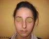Rinoplastie primara - Caz 2