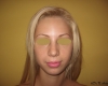 Rinoplastie primara - Caz 1
