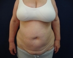 Abdominoplastie - Caz 2-abdominoplastie