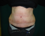 Abdominoplastie - Caz 2-abdominoplastie