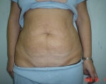 Abdominoplastie - Caz 1 - abdominoplastie