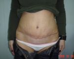Abdominoplastie - Caz 1 - abdominoplastie