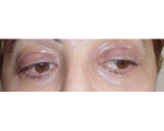 Blefaroplastie - Caz 1