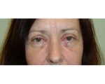 Blefaroplastie - Caz2