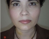 Lifting facial - Caz 1- lifting facial