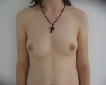 Marire sani - Caz 13 - implant mamar caz 13
