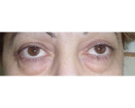Blefaroplastie - Caz 1