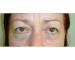 Blefaroplastie - Caz2
