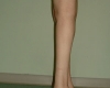 Implant gambe - Caz 2 - implant gambe