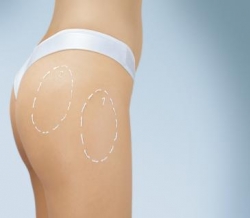 Chirurgia siluetei - Lipoaspiratie