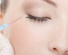 Chirurgia fetei - Tratament facial cu acid hialuronic