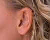Chirurgia fetei - Otoplastia