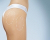 Chirurgia siluetei - Lipoaspiratie